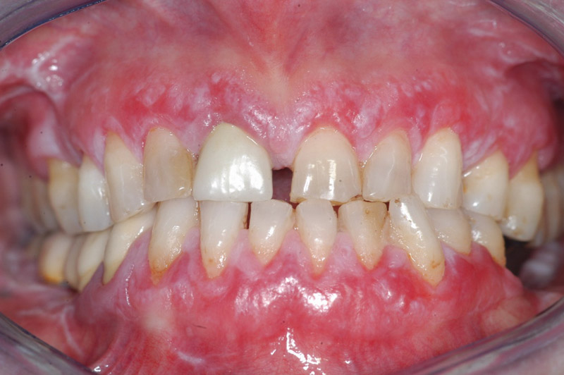 White Spots On Gums Cancer